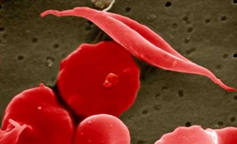 CRISPR: laboratorios afirman haber curado a primeros pacientes con enfermedades hereditarias a la sangre